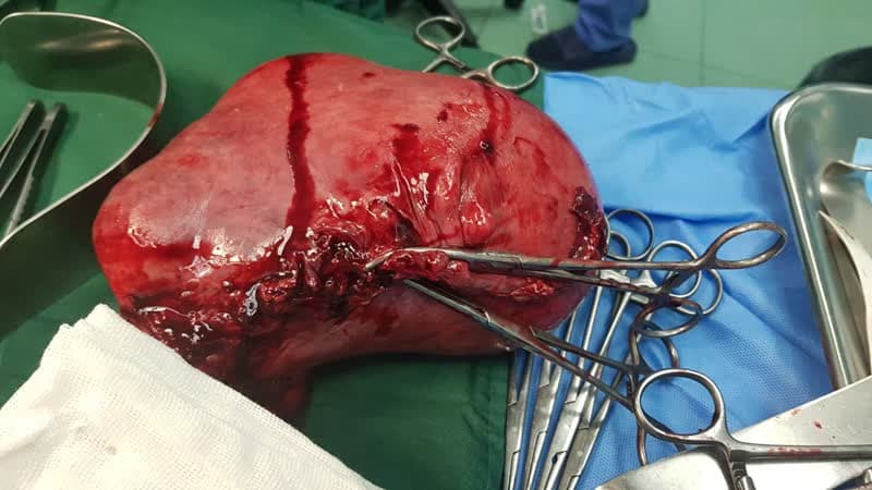 جراحی موفق برداشتن توده ۲ کیلویی در بیمارستان تأمیناجتماعی قم